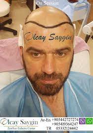 Google Hair Transplant Results Hair Transplant Best Hair Transplant