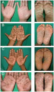 Image result for Secondary Syphilis