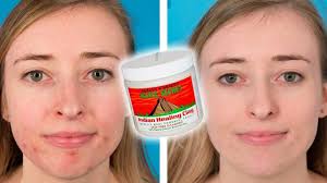 People Try The Aztec Healing Clay Face Mask For Their Acne Youtube Healing Clay Clay Face Mask Indian Healing Clay