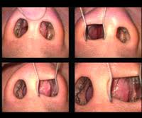Polyps in general, are benign growths in mucus membranes. Nose Diagnosis Epistaxis Nose Bleeding Foreign Body Inhalation Common Cold Allergic Rhinitis