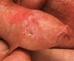 Human papillomavirus (hpv) is the most common viral infection of the reproductive tract. Hpv Typ 33 Assoziierte Intraepitheliale Neoplasie Des Penis Pin Springerlink