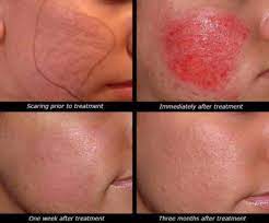 Arastirdim Gittim Ve Dermapen Yaptirdim Dermapen Hakkinda Her Sey Kizlarsoruyor