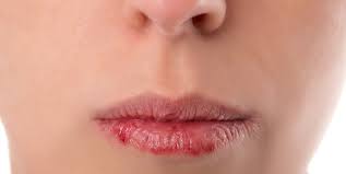 Wer denkt im winter schon an sonnenschutz? Schmerzhaft Und Unschon Risiko Sonnenbrand Auf Den Lippen Haut De