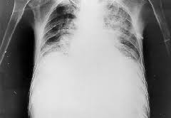 Rinocerebral, pulmonar, digestiva, cutánea y renal. Https Www Medigraphic Com Pdfs Micro Ei 1999 Ei992e Pdf