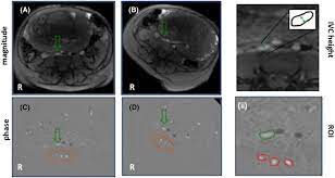 Check spelling or type a new query. The Effect Of Maternal Position On Venous Return For Pregnant Women During Mri Hughes 2021 Nmr In Biomedicine Wiley Online Library