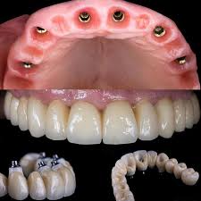 Screw Retained Dental Implants Dental Implants Cost Dental Implants Implant Dentist