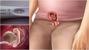 5 sakit perut tanda hamil itu seperti apa? Wanita Harus Paham Contoh Keputihan Tanda Hamil 1 Minggu Blog Review Dan Opini