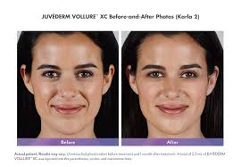 It takes/took/will take me/tom/them a week/a long time/three hours + to do. Juvederm Dermal Fillers Sikara Medspa Las Vegas Nv