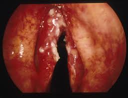 Difficulty breathing, also known as dyspnoea, is a symptom that might signal an obstruction in the respiratory tracts. 5 Throat Cancer Signs And Symptoms With Pictures 2020 Adventis