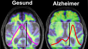 The approval could bring hope to the. Demenz Fruherkennung Ein Bluttest Verrat Das Alzheimer Risiko Br Wissen