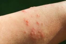 Image result for contact dermatitis