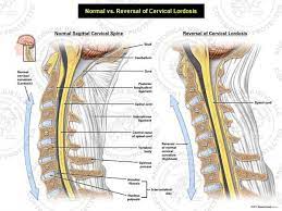 Medical Art Normal Vs Reversal Of Cervical Lordosis Stock Medical Illustrations Cervical Cervical Spinal Stenosis Medical Art