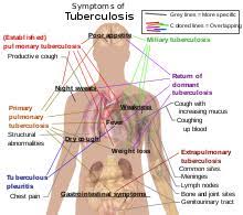 Korset adalah salah satu alat yang bisa menyiksa diri dan terkenal dapat membuat badan sakit. Tuberkulosis Wikipedia Bahasa Indonesia Ensiklopedia Bebas
