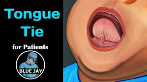 Image result for Ankyloglossia