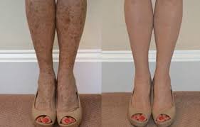 Image result for brown patches on the feet