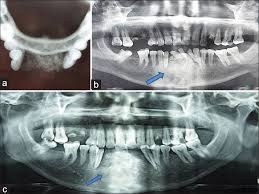 Chondroblastic os may be difficult to distinguish from. Primary Juxtacortical Chondrosarcoma Of Mandibular Symphysis Unique And Rare Case Report Bakyalakshmi K Jayachandran S Sureshkumar M J Can Res Ther