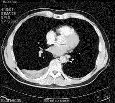 Tromboembolismo pulmonar clasificación y recursos externos. Tromboembolismo Pulmonar El Valor De La Clinica