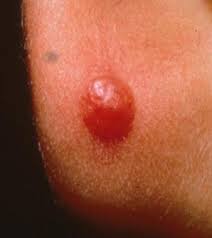 Image result for Spitz Nevus