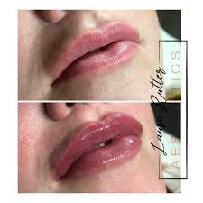 Balanced aesthetics, serves the greater atlanta area, and is located in buckhead. L R Aesthetics Lip Journey This Is The 3rd Treatment This Lady Has Had With Me Look At That Shape Lips Lipgoals Aesthetic Nonsurgical Beauty Celebrities Southyorkshire Injectables Restylanelips