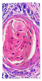 For some reason epithelial pearls are not customarily found in carcinoma in situ. Squamous Cell Carcinoma Keratin Pearl Bath Towel For Sale By Garry Delong