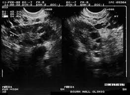 This is call transvaginal pelvic ultrasound. Transvaginal Ultrasonography Of Right And Left Normal Ovaries Upper Download Scientific Diagram