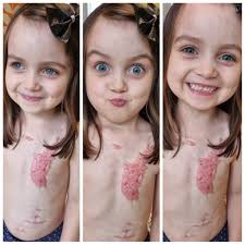 Children's Burns Trust