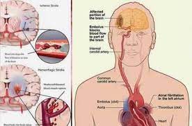 Gula darah tinggi atau dikenal dengan hiperglikemia adalah kondisi ketika kadar glukosa di dalam darah mengalami kenaikan. Cara Menyembuhkan Darah Beku Di Otak Dengan Cepat Ketika Berbicara Tentang Penyakit Darah Beku Di Ota Carotid Artery Emergency Medical Internal Carotid Artery