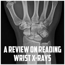 Image result for Wrist XRay