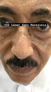 Excellent results with just a single sitting of Fractional CO2 laser for  removal of Seborrheic keratosis