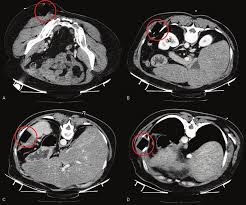 Fabian identifying the muscles and landmarks of the abdomen and chest. Chest Abdomen Ct Scan With Contrast Medium Patient In Prone Position Download Scientific Diagram