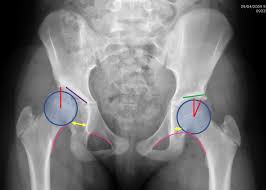 Image result for Hip XRay