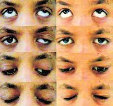 Lid lag is most commonly associated with graves' disease although it. Conjunctival Route Levator Plication For Ptosis Ento Key