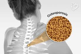 Resultado de imagen para imagenes de osteoporosis