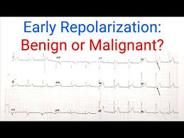 Image result for Early Repolarization