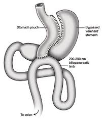 Overall, vertical sleeve gastrectomy is less risky than gastric bypass, but you'll have to check with your insurance provider first to ensure that it is covered. Mini Gastric Bypass Mgb Single Anastamosis Or Omega Loop Gastric Bypass In London Uk