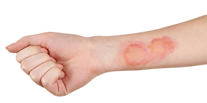 Minor Burns