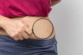 Tips To Prevent And How To Get Rid Of Stretch Marks | Stretch Marks  Prevention & Home Remedies To Remove Stretch Marks