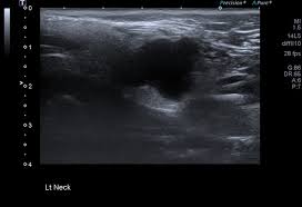 Bronchial carcinoid tumors, cancer (philad.), y. Parotid Mucoepidermoid Carcinoma Radiology Case Radiopaedia Org