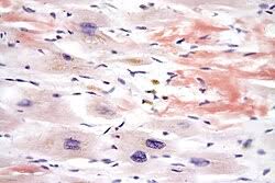 Image result for Restrictive Cardiomyopathy