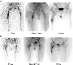 Image result for Osteomyelitis Bone Scan