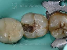 Add some drops of mustard oil to 1 teaspoon of salt and make a paste. How Much Does It Cost To Treat Tooth Decay Cozzolino Zerodonto Dental Office