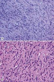 When physicians know the types of cells involved, they are able to personalize the treatment plan. Sarcomatoid Malignant Mesothelioma Thoracic Pathology A Volume In The High Yield Pathology Series Expert Consult Online And Print 1st Edition
