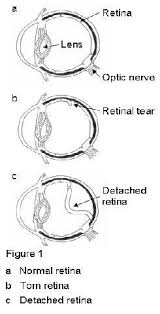 Check spelling or type a new query. Retinal Detachment Surgery Ramsay Health Care