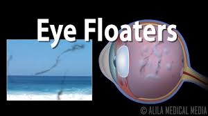 Your retina specialist can use a special laser to surround the tear and seal it to prevent it from detaching. Eye Floaters And Flashes Animation Youtube