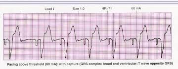 Image result for Transcutaneous Pacing