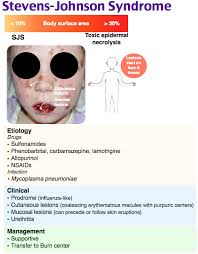 What is steven johnson syndrome. Steven Johnson Syndrome Steven Johnson Syndrome Medical School Studying Nursing Mnemonics