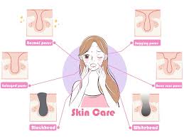 The best way to remove blackheads is to prep the skin with light exfoliation in the shower. Nose Blackheads 15 Best Ways To Remove Black Clogged Pores On Nose