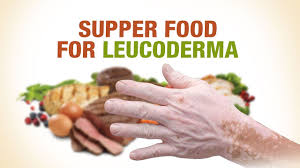 Supper Foods For Leucoderma Dr Nitika Kohli Aimil