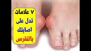 7 علامات تدل على اصابتك بالنقرس 7 اعراض للاصابة بمرض النقرس youtube