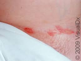 Image result for sore skin in the groin area